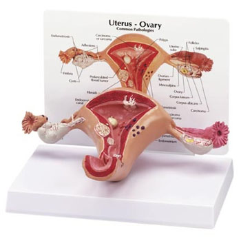 여성자궁질환모형(G348)